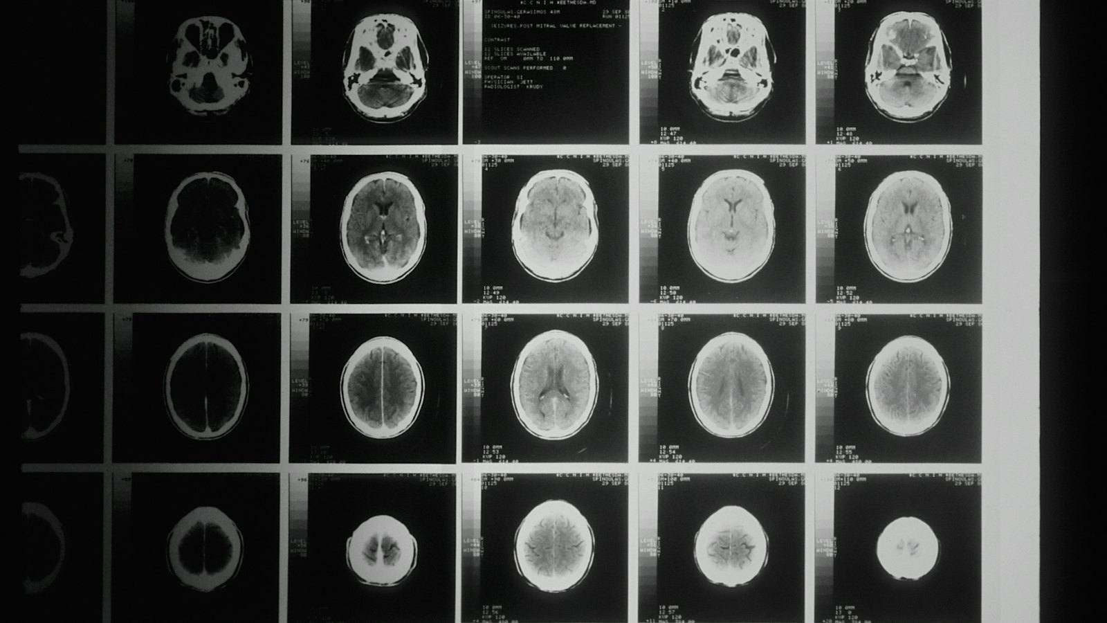 Grid of CT brain scan slices on a lightbox